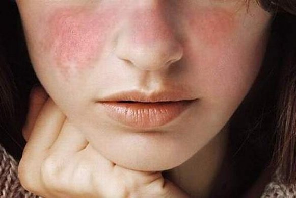 Lupus-image-620×388