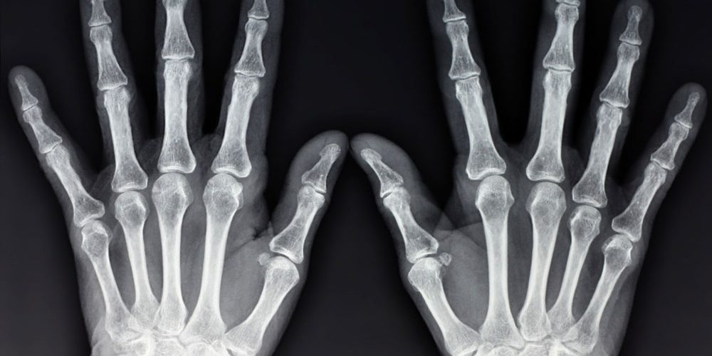 SBR – Rede TV – Osteoartrite