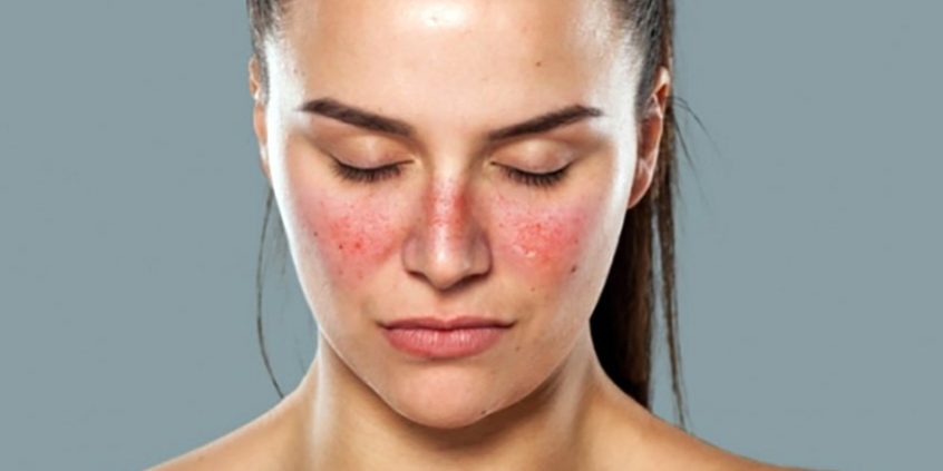 Lúpus é um doença reumática