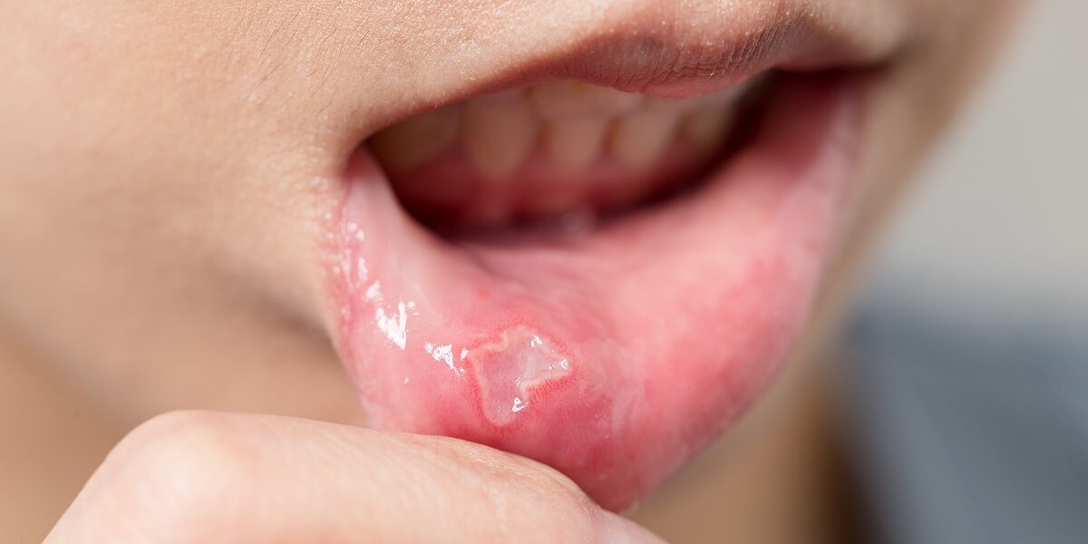 Woman suffer from aphtha on mouth